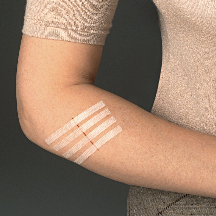 3M Steri-Strip Wundverschlussstreifen 6 x 75 mm (50 x 3 Streifen) Klinikpackung